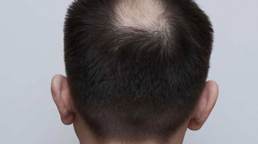 Da una perdita di capelli con cipolle e
